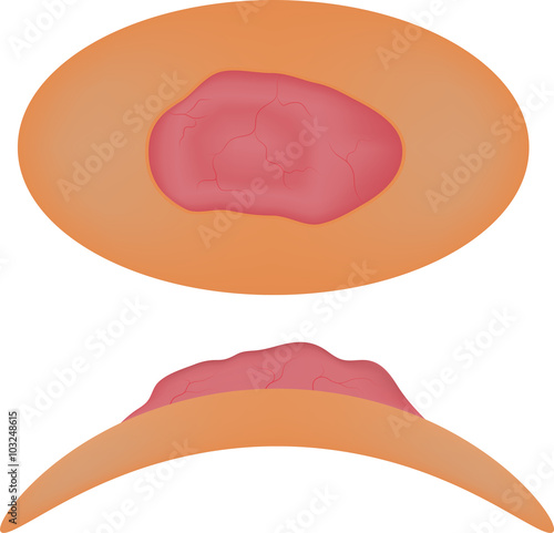 Basal Cell Carcinoma