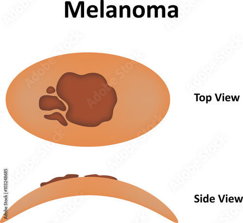 Melanoma Labeled Diagram