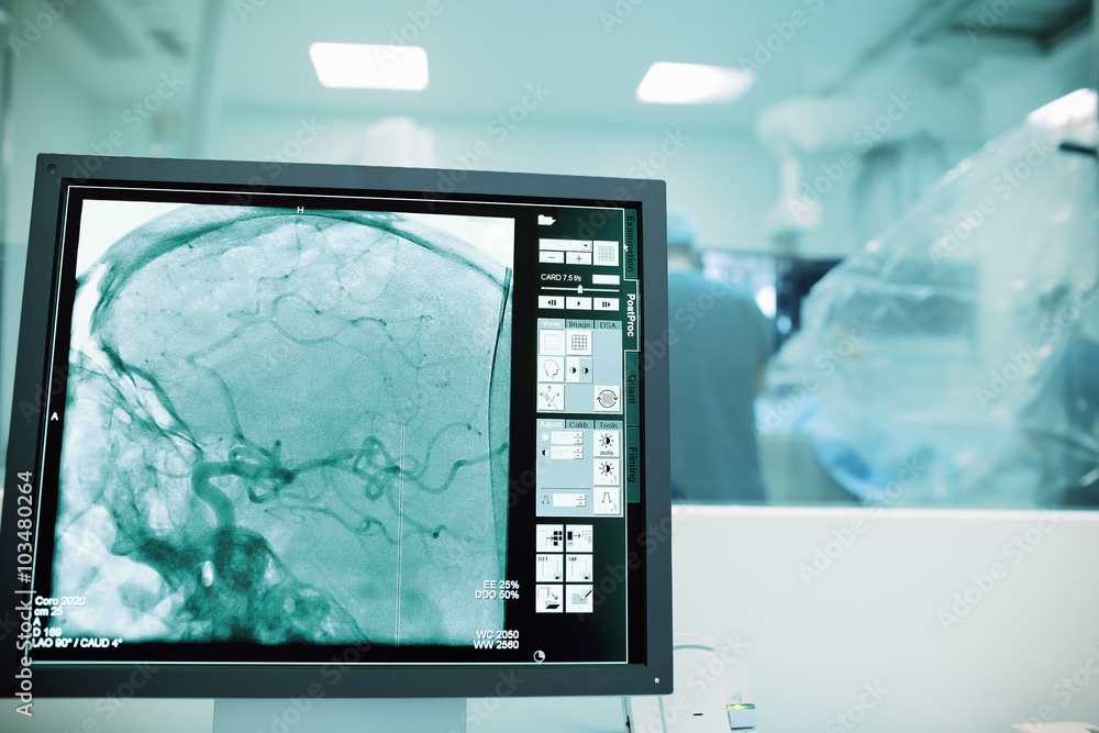 Monitoring of cerebral vessels during surgery Monitoring of cerebral vessels during surgery