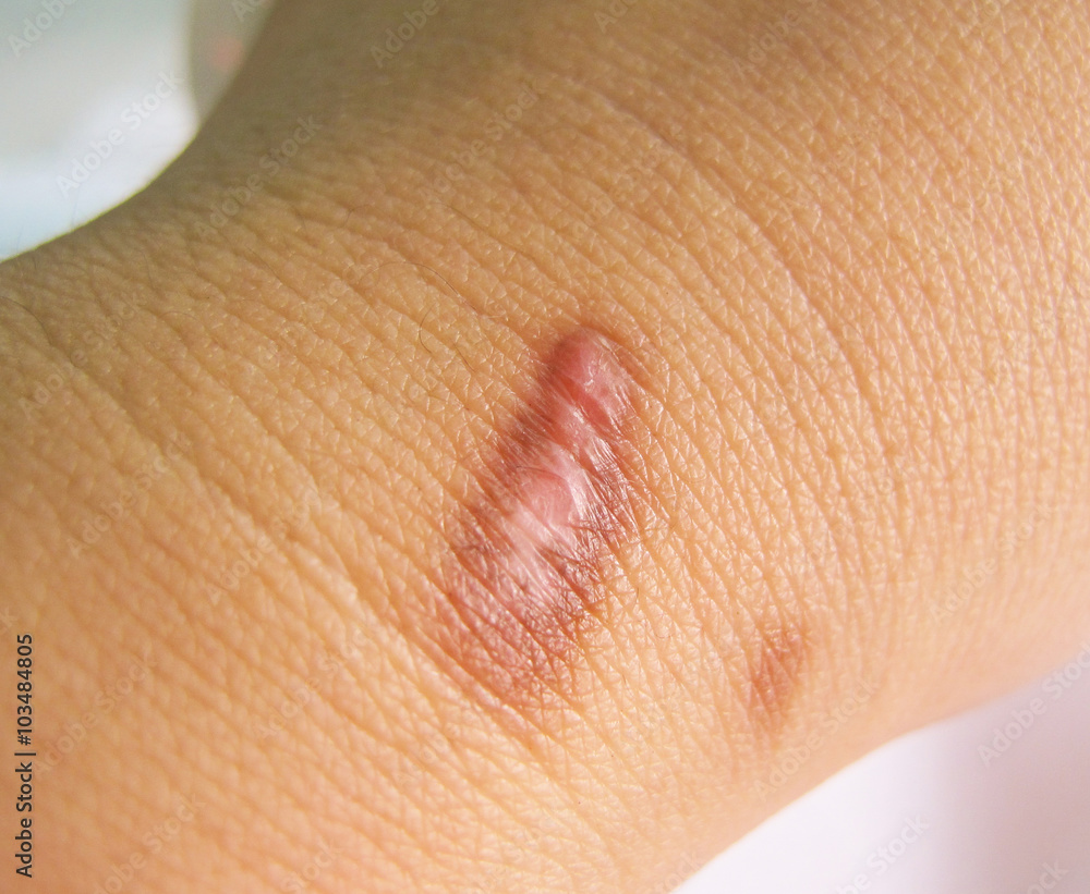 Fototapeta premium Scar on human skin