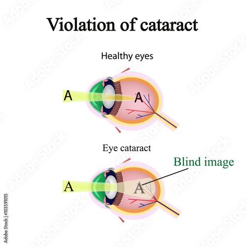 The structure of the eye. Cataracts. As the affected eye sees cataracts. Violation of cataract
