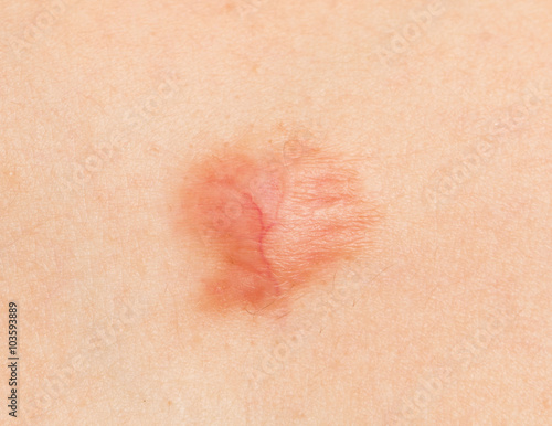 round scar on the skin burn