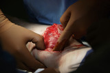 Muslce Surgery.
Leg surgery with calf muscle uncovered and surgeon's fingers pulling out the skin.