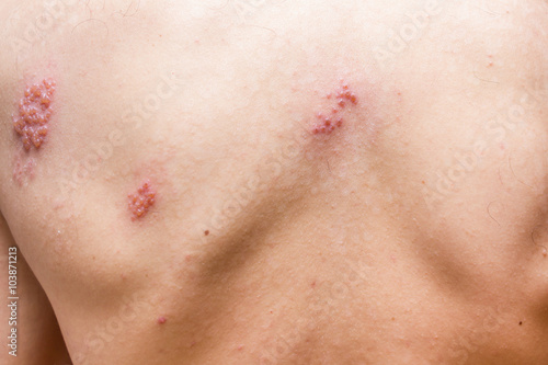 Shingles on men herpes zoster. Closeup. photo