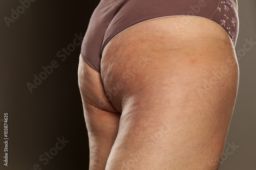 obese female buttocks with cellulite and stretch marks