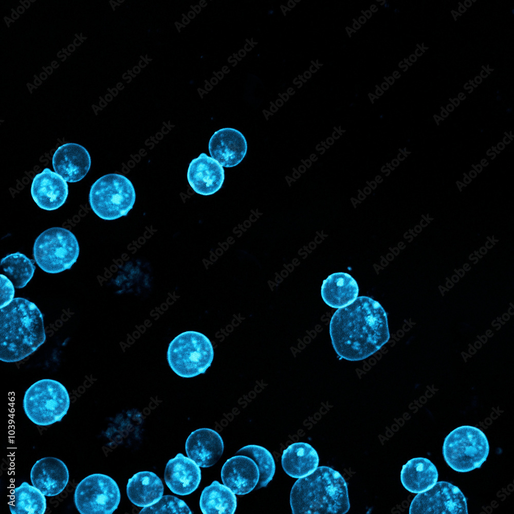 Leukemic cells labeled with fluorescent molecules Leukemic cells labeled with fluorescent molecules