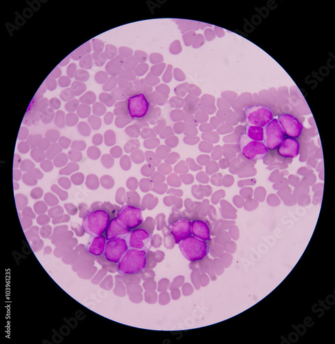 Myeloblasts showing in blood smear. photo