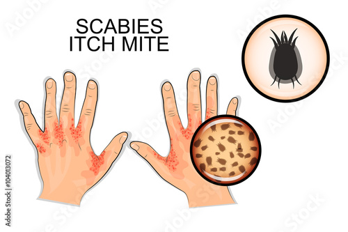 the infection of scabies. itch mite photo