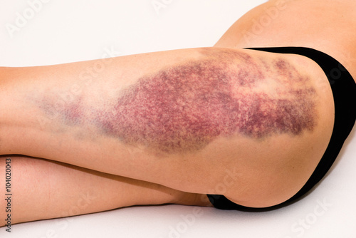 Bruise on wounded woman leg photo