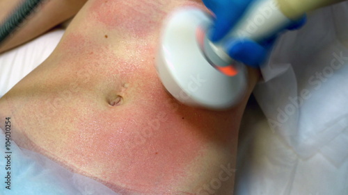 RF-lifting on abdomen of caucasian woman