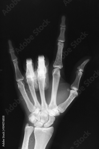 Hand sign (I love you ) X-ray film
