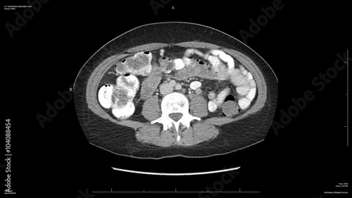 Abdomen CAT scan animation with view of pancreas cyst