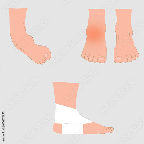 Dislocation of the foot. Vector illustration