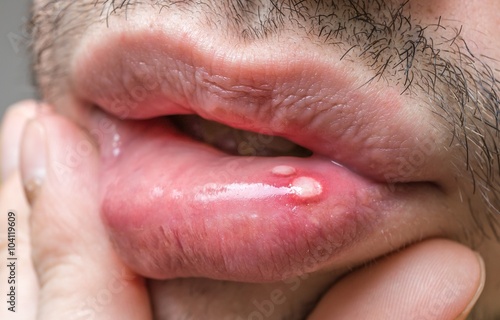 Foto Painful aphtha ulcer on man's mouth.