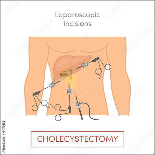 Laparoscopic cholecystectomy - gallbladder removal