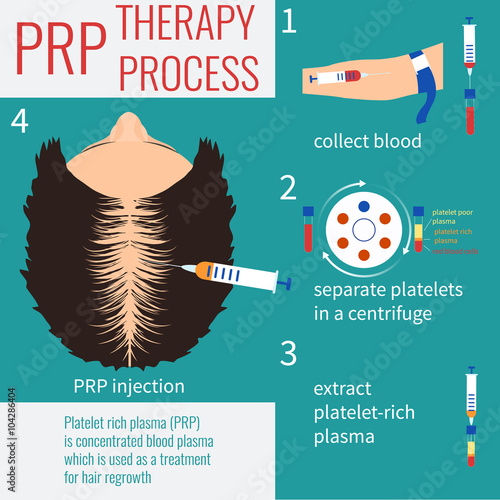 Platelet rich plasma injection. PRP therapy process. Hair loss treatment. Injection. Mesotherapy. Hair growth stimulation. Transplantation of hair.