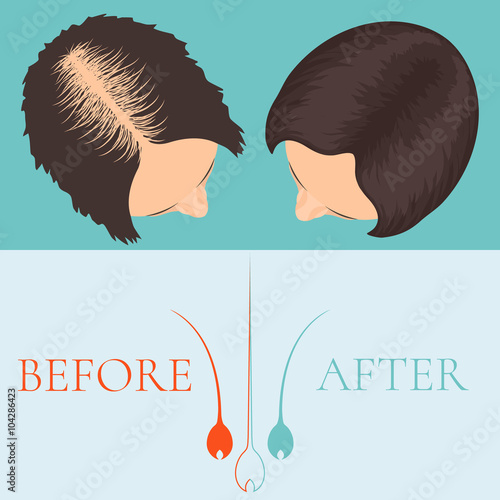 Top view of a woman before and after hair treatment and hair transplantation. Female alopecia. Hair care concept. Hair bulb logo. Hair loss clinic concept design. Vector illustration.