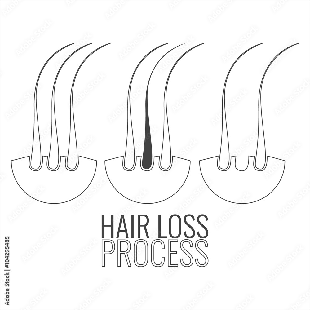 Hair loss process. Hair medical diagnostics symbol set. Hair bulb