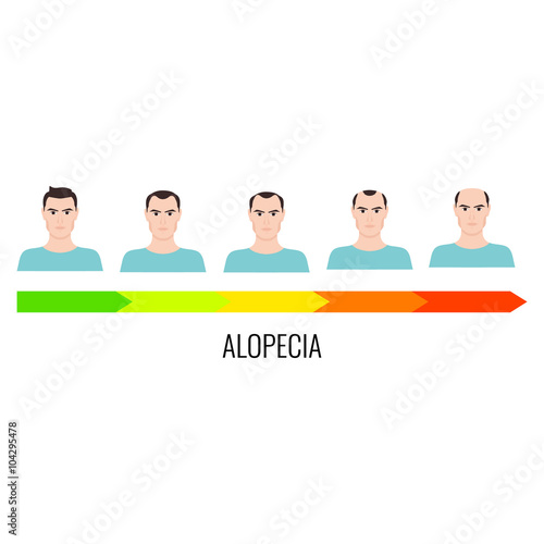 Alopecia stages set. Front view of a man losing hair. Male baldness. Male hair loss pattern. Human hair growth. Hair care concept. Vector illustration.