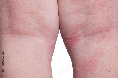 Eczema on the kid's legs