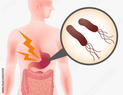 human stomach and Helicobacter pylori, stomach ache, gastric ulcer, simplified illustration