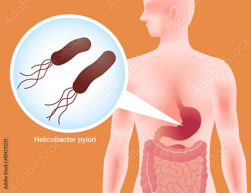 human stomach and Helicobacter pylori, stomach ache, gastric ulcer, simplified illustration