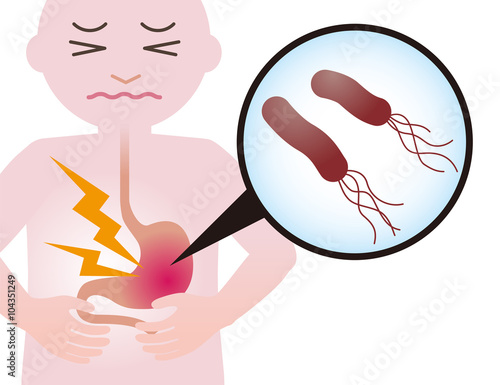 human stomach and Helicobacter pylori, stomach ache, gastric ulcer, simplified illustration
