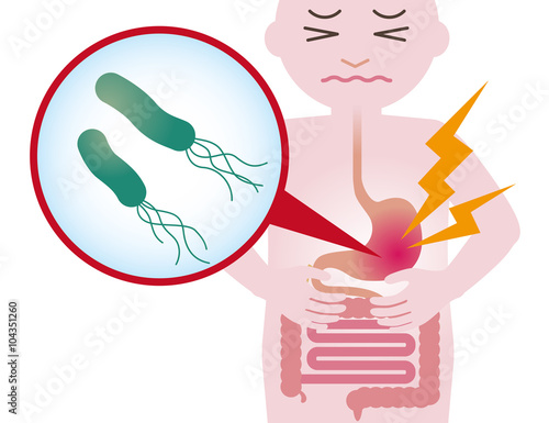 human stomach and Helicobacter pylori, stomach ache, gastric ulcer, simplified illustration
