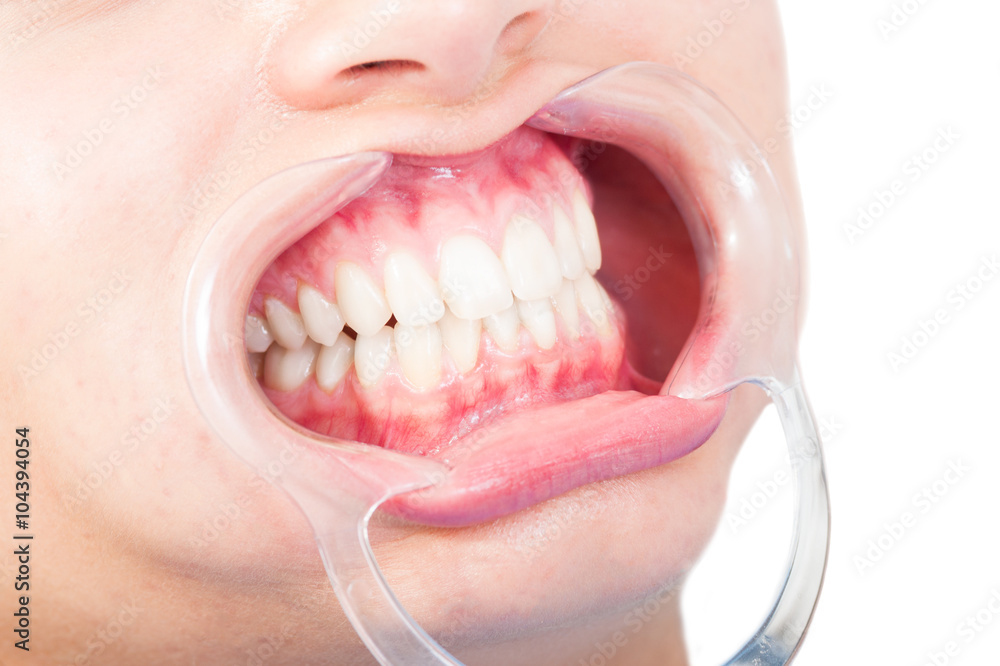 Obraz premium Closeup of woman mouth with plastic retractor