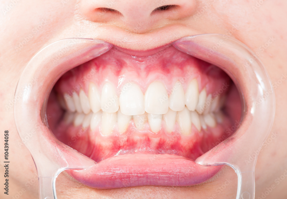 Obraz premium Close-up of frontal view of woman white teeth