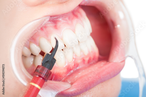 Close up of female mouth with retractor and composite