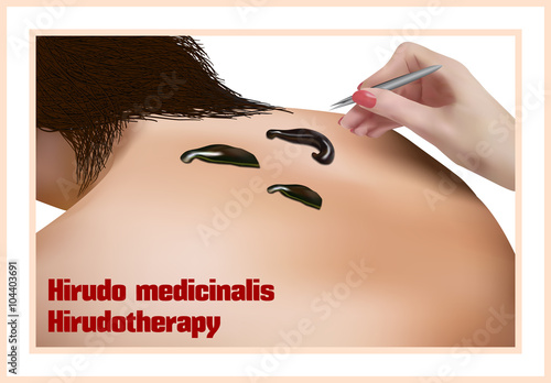 Hirudo medicinalis. Hirudotherapy.
Treatment with leeches.