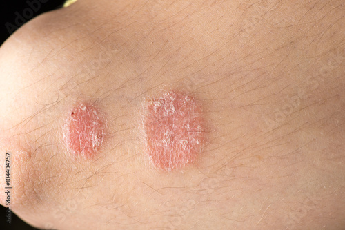 skin disease psoriasis closeup photo
