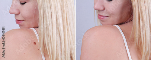 Laser treatment for birthmark removal before and after.