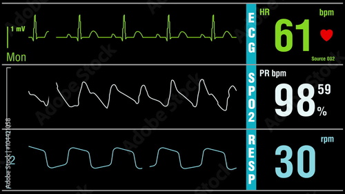Looped: Patient monitor displays vital signs ECG electrocardiogram EKG, oxygen saturation SPO2 and respiration. Medical examination. Loopable 4K UHD video footage animation.