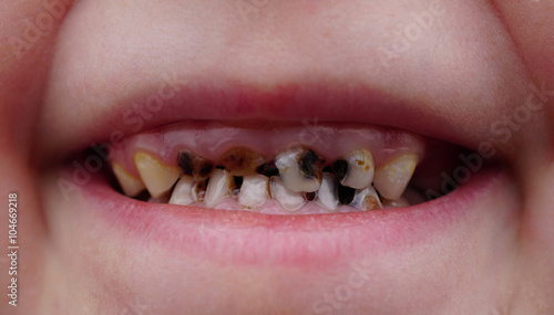 caries on teeth of the child