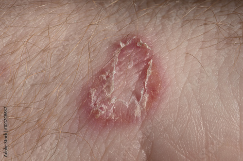 Ringworm on white man / Mycosis