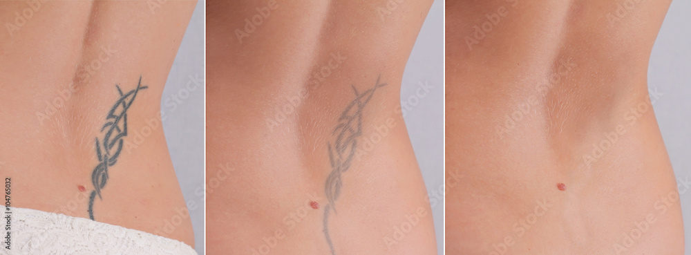 Laser tattoo removal before and after. Beautiful young woman with tattoo on  her back Stock Photo | Adobe Stock