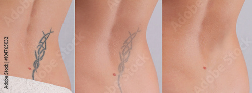 Photos Laser tattoo removal before and after