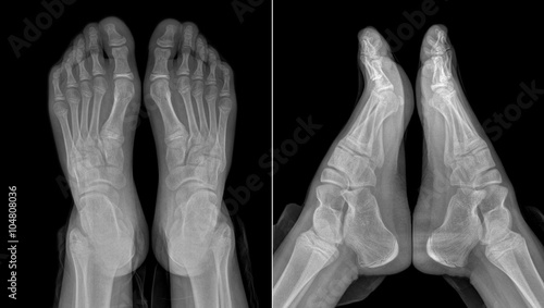 X-ray image of the girl's feet (with partially outlined trousers)