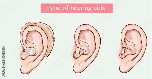  vector illustration of a Type of hearing aids