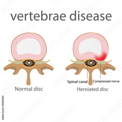 back pain. herniated disc. vertebrae disease vector format