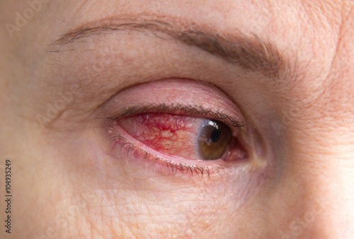 severe eye injury with blood 