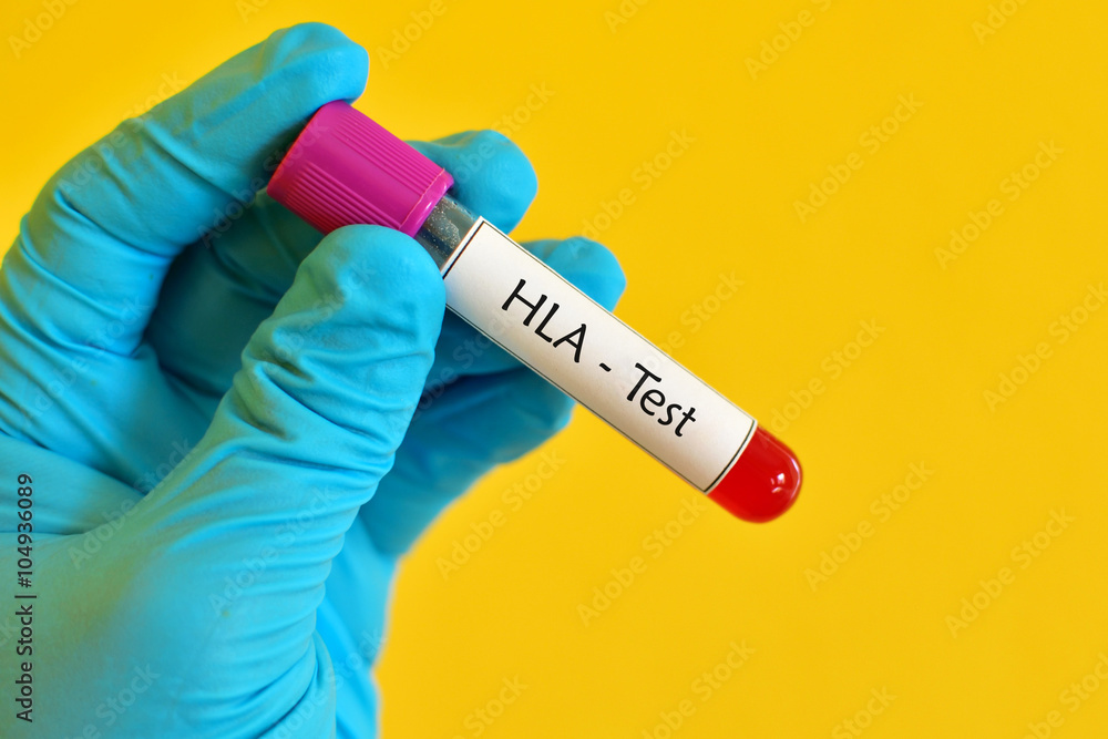 Fototapeta premium Blood sample for HLA (Human Leukocyte Antigen) test 