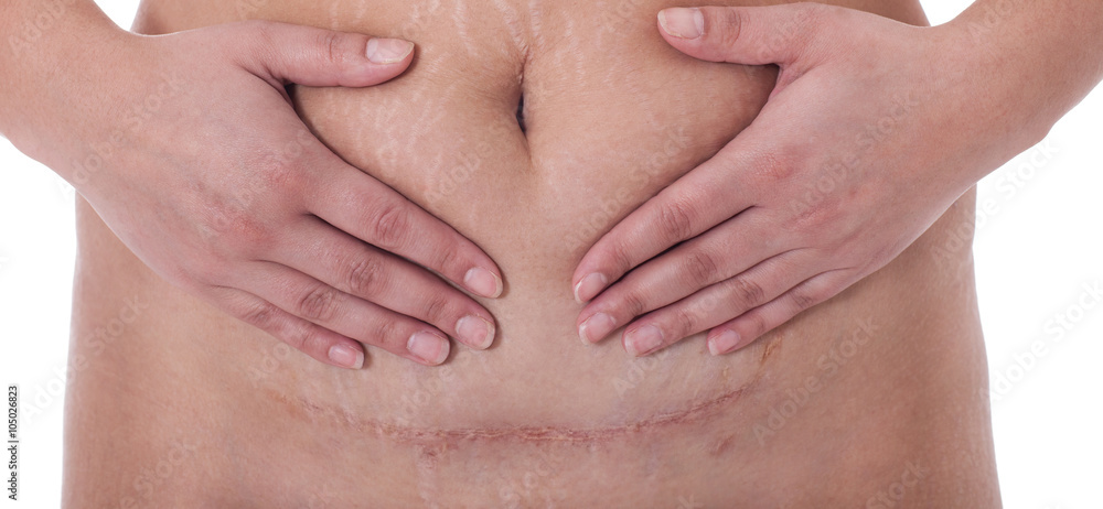 Scar after a Caesarean section, Bikini line Scar after a Caesarean section, Bikini line