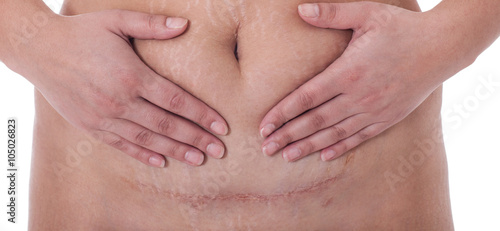 Tableau sur toile Scar after a Caesarean section, Bikini line