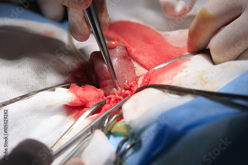 Suture the Stoma / macro suturing the intestine during the stoma operation photo