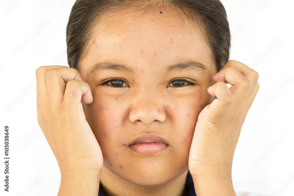 Lady to unhappy with chickenpox on face Lady to unhappy with chickenpox on face