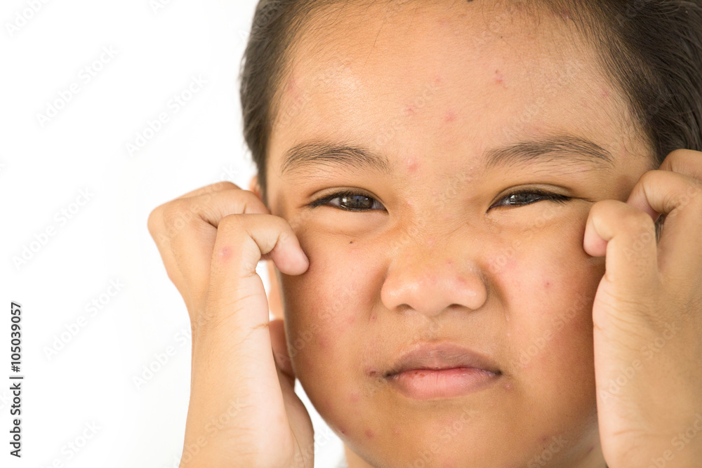 Lady to unhappy with chickenpox on face
