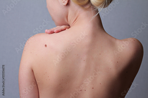 Checking benign moles : Woman with birthmarks on her back . Sun Exposure effect on skin, Health Effects of UV Radiation